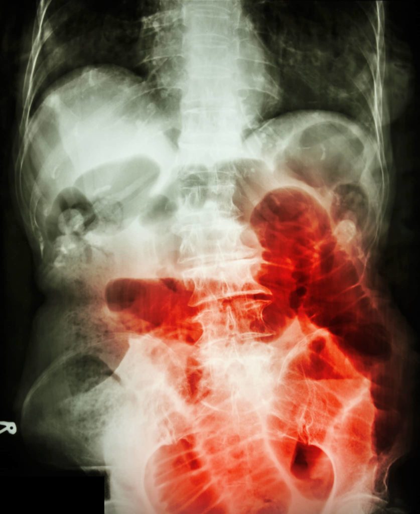 Small bowel obstruction.  Film X-ray abdomen supine :  show small bowel dilated due to small bowel obstruction